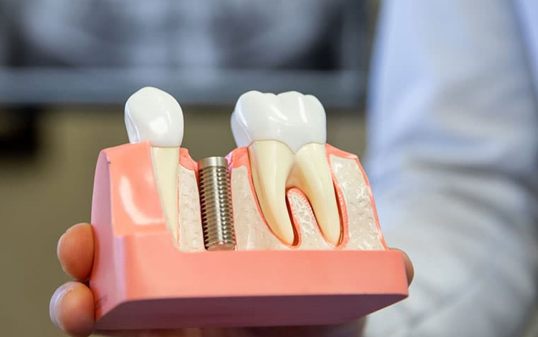 dental implants
