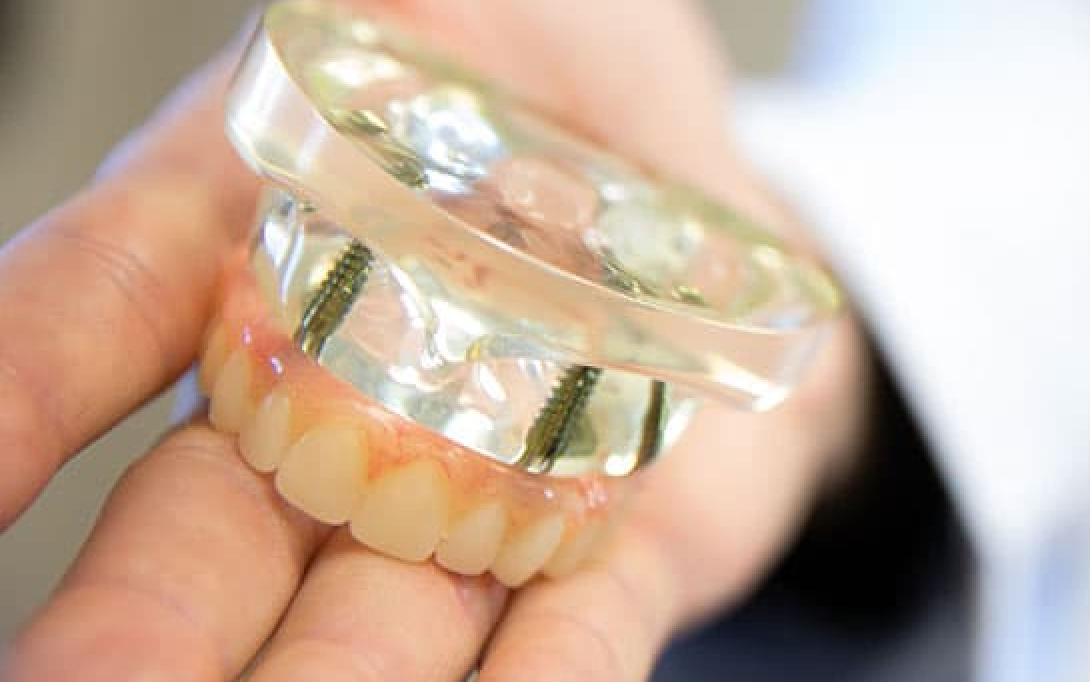 full mouth dental implants model