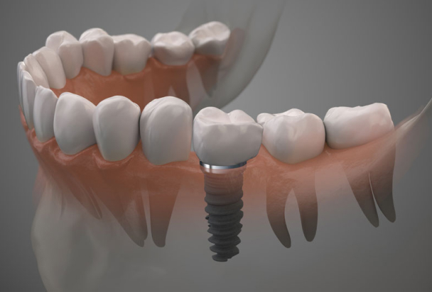 dental implant model 3d render