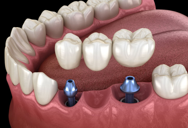 dental implant model 3d render