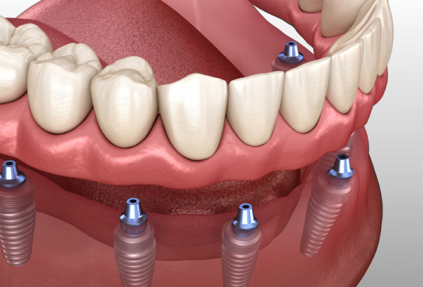 dental implant model 3d render