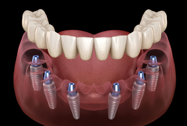 dental implant model 3d render