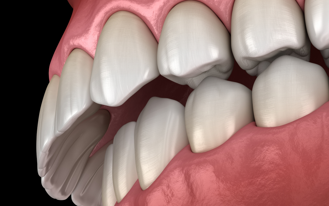 malocclusion 3d render