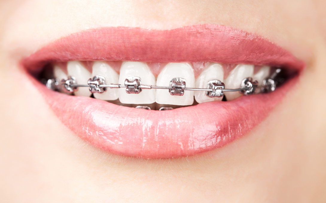 close up of mouth with braces
