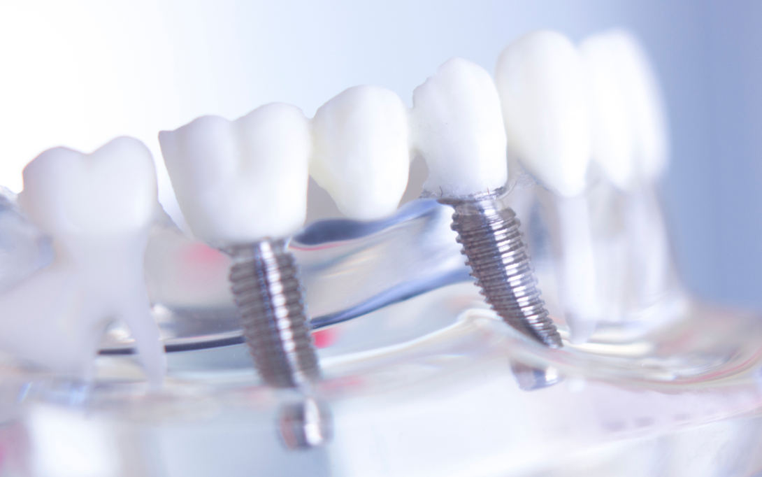dental implant bridge model
