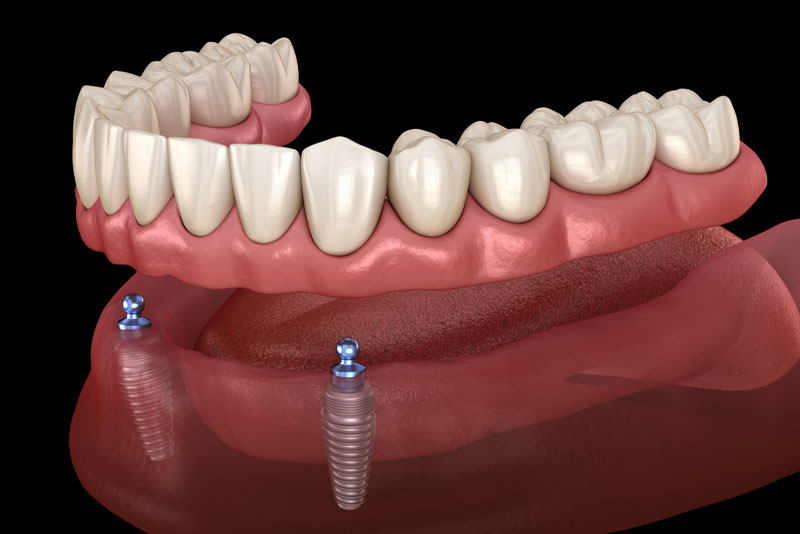 implant-supported dentures